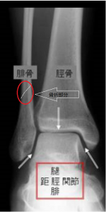 腓骨骨折